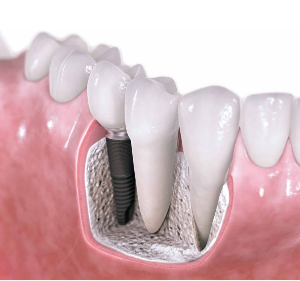 Implantes Dentários
